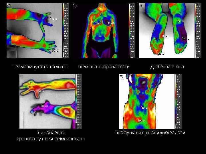  Термоампутація пальців Ішемічна хвороба серця Діабетна стопа Відновлення кровообігу після реімплантації Гіпофункція щитовидної