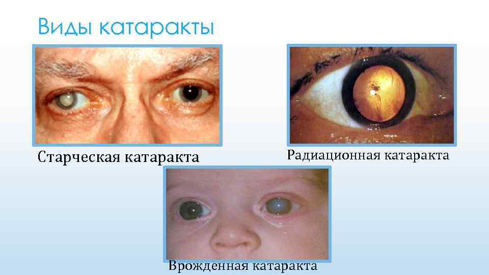 Виды катаракты Старческая катаракта Радиационная катаракта Врожденная катаракта 