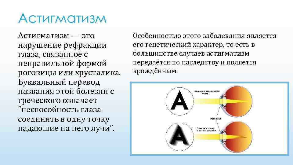 Астигматизм — это нарушение рефракции глаза, связанное с неправильной формой роговицы или хрусталика. Буквальный