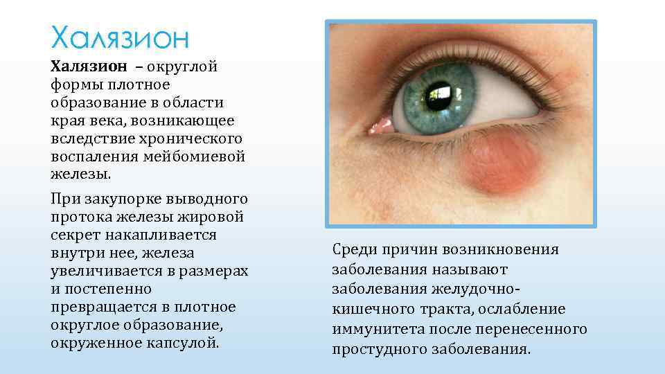 Халязион – округлой формы плотное образование в области края века, возникающее вследствие хронического воспаления