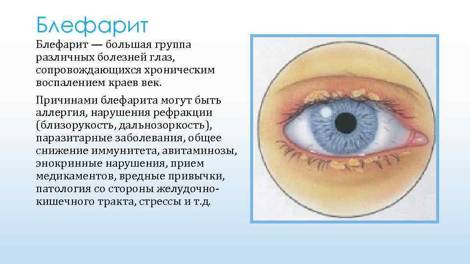 Блефарит — большая группа различных болезней глаз, сопровождающихся хроническим воспалением краев век. Причинами блефарита