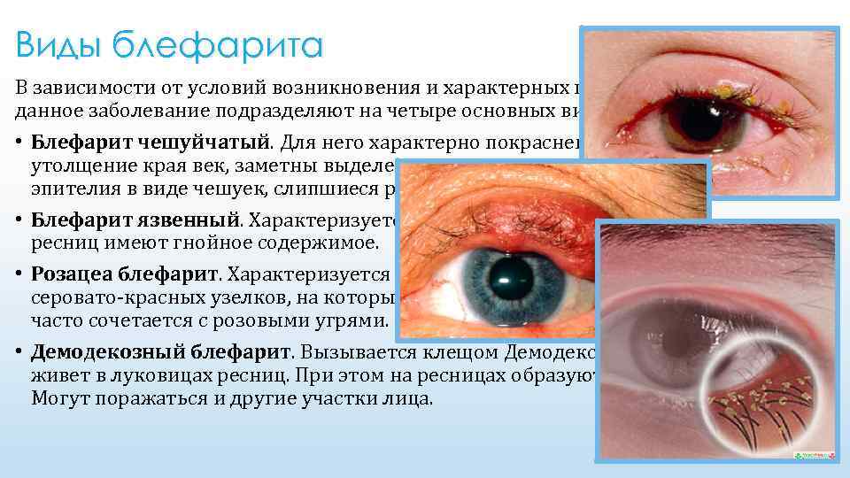 Виды блефарита В зависимости от условий возникновения и характерных признаков данное заболевание подразделяют на