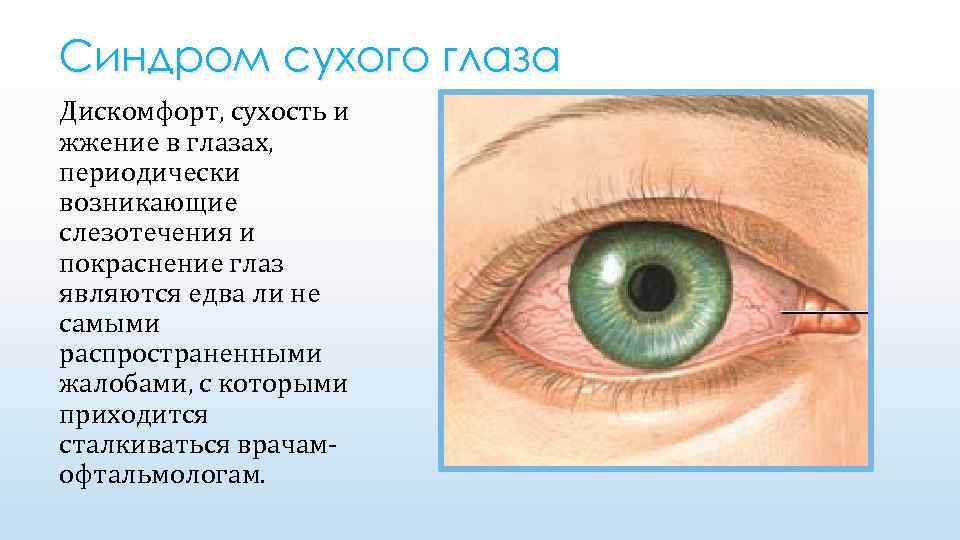 Синдром сухого глаза Дискомфорт, сухость и жжение в глазах, периодически возникающие слезотечения и покраснение