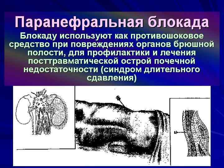 Концентрация новокаина для паранефральной блокады. Паранефральная блокада по Вишневскому. Паранефральные новокаиновые блокады. Паранефральная блокада по Вишневскому показания. Паранефральную блокаду по а.в. Вишневскому.