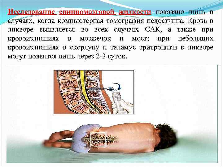 Исследование спинномозговой жидкости показано лишь в случаях, когда компьютерная томография недоступна. Кровь в ликворе