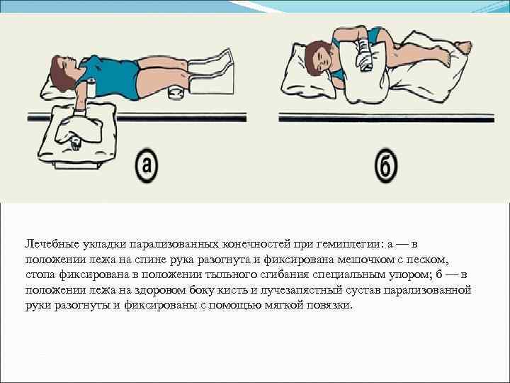 Лечебные укладки парализованных конечностей при гемиплегии: а — в положении лежа на спине рука