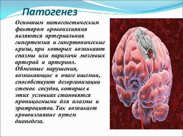 Патогенез Основным патогенетическим фактором кровоизлияния являются артериальная гипертензия и гипертонические кризы, при которых возникают