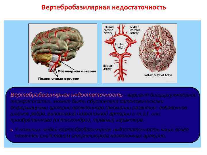 Вертебробазилярная недостаточность - вариант дисциркуляторной энцефалопатии, может быть обусловлена патологическими деформациями артерий врожденного (аномалии