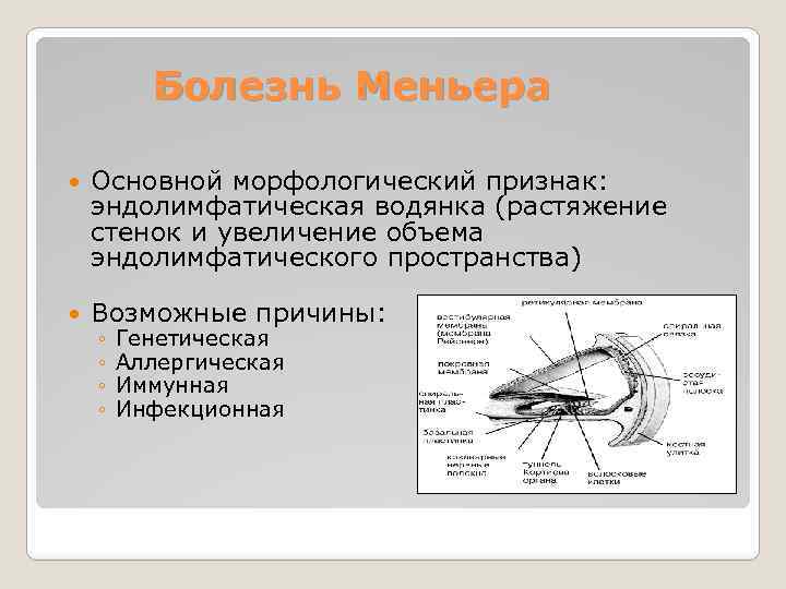 Болезнь Меньера Основной морфологический признак: эндолимфатическая водянка (растяжение стенок и увеличение объема эндолимфатического пространства)