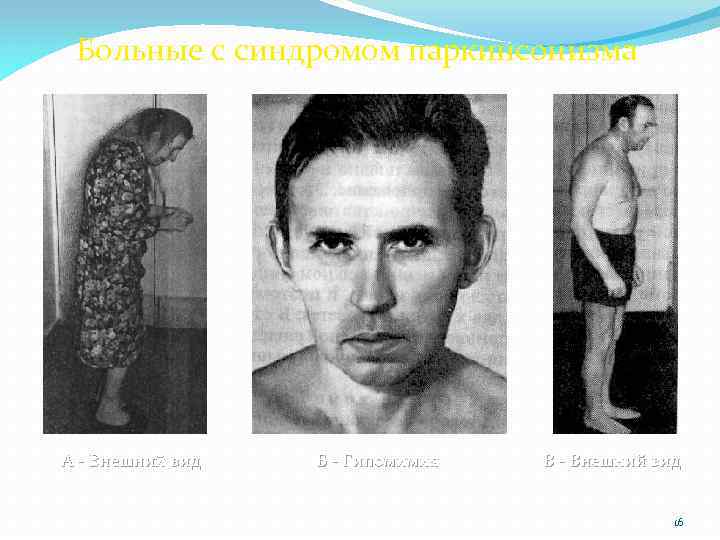 Больные с синдромом паркинсонизма А - Внешний вид Б - Гипомимия В - Внешний