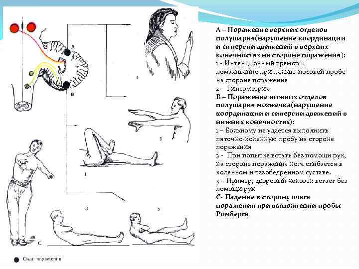 А – Поражение верхних отделов полушария(нарушение координации и синергии движений в верхних конечностях на