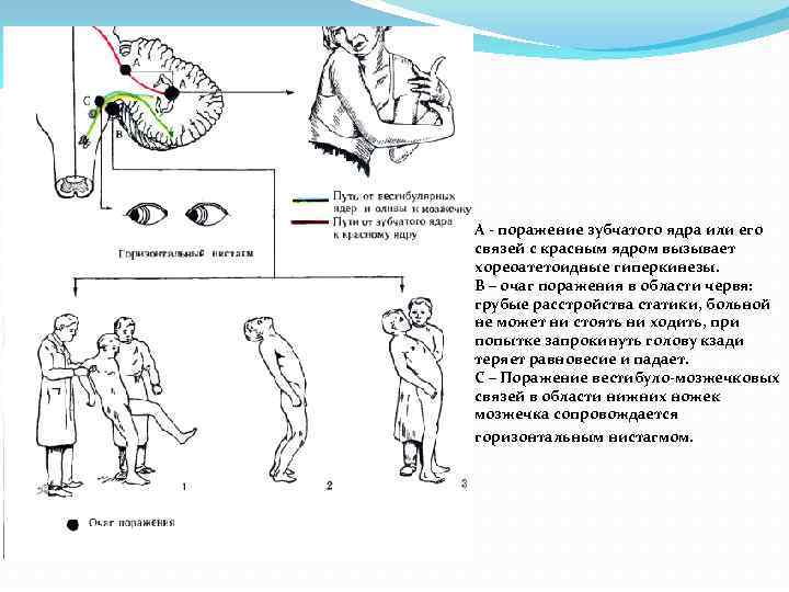 А - поражение зубчатого ядра или его связей с красным ядром вызывает хореоатетоидные гиперкинезы.