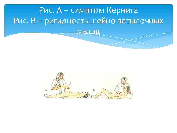 Рис. А – симптом Кернига Рис. В – ригидность шейно-затылочных мышц 