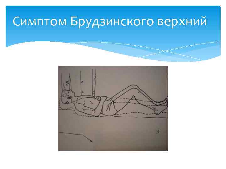 Симптом Брудзинского верхний 