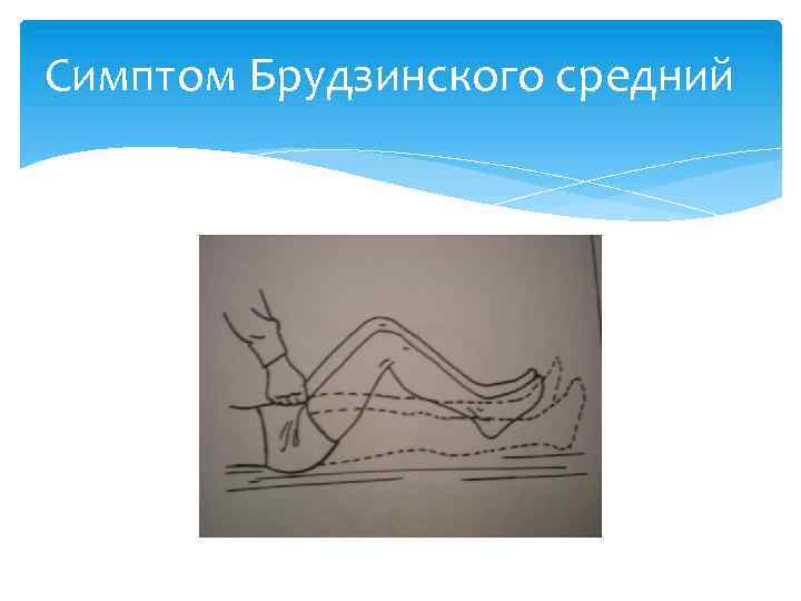 Симптом Брудзинского средний 