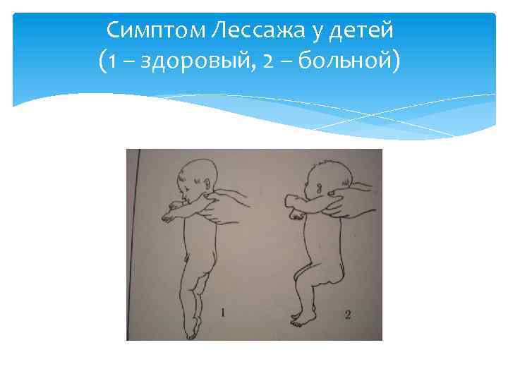 Симптом Лессажа у детей (1 – здоровый, 2 – больной) 