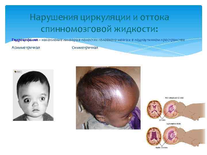 Нарушения циркуляции и оттока спинномозговой жидкости: Гидроцефалия – накопление ликвора в полостях головного мозга