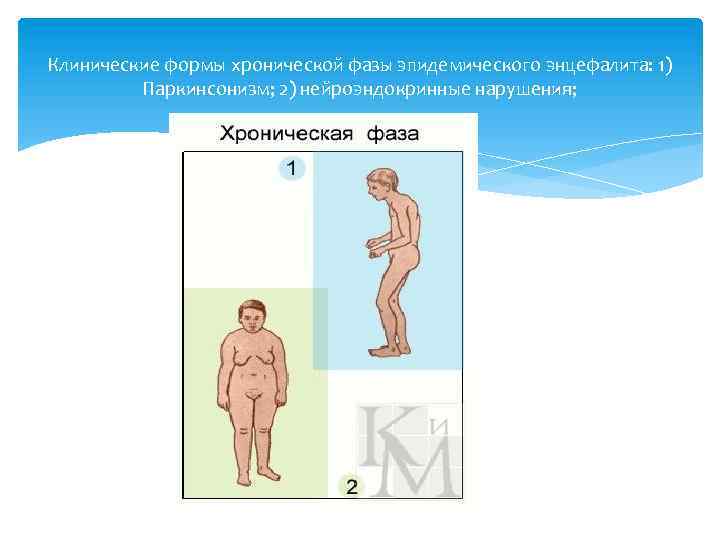 Клинические формы хронической фазы эпидемического энцефалита: 1) Паркинсонизм; 2) нейроэндокринные нарушения; 