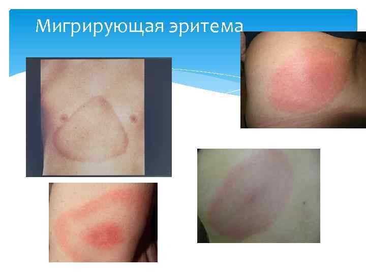 Мигрирующая эритема 