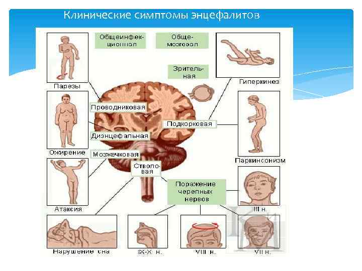 Клинические симптомы энцефалитов 