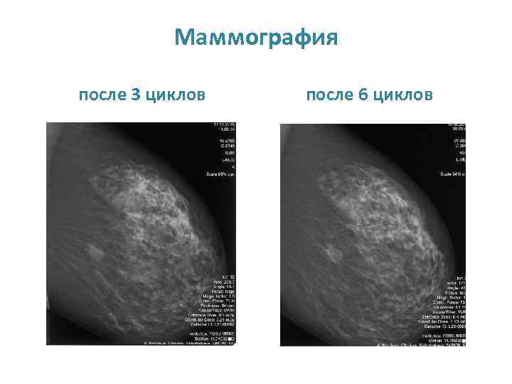 Маммография после 3 циклов после 6 циклов 
