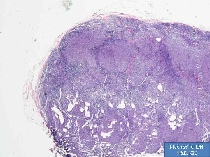 Mediastinal L/N, H&E, X 20 