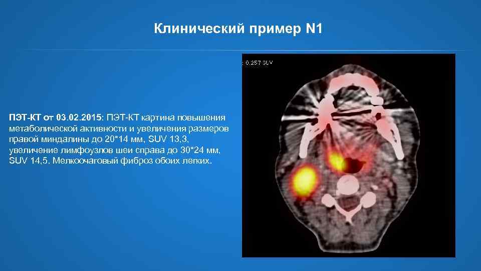 Клинический пример N 1 ПЭТ-КТ от 03. 02. 2015: ПЭТ-КТ картина повышения метаболической активности