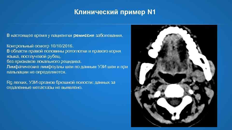 Клинический пример N 1 В настоящее время у пациентки ремиссия заболевания. Контрольный осмотр 10/10/2016.