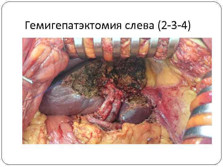 Гемигепатэктомия слева (2 -3 -4) 