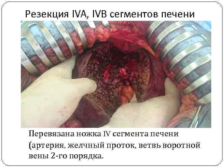 Резекция IVA, IVВ сегментов печени Перевязана ножка IV сегмента печени (артерия, желчный проток, ветвь