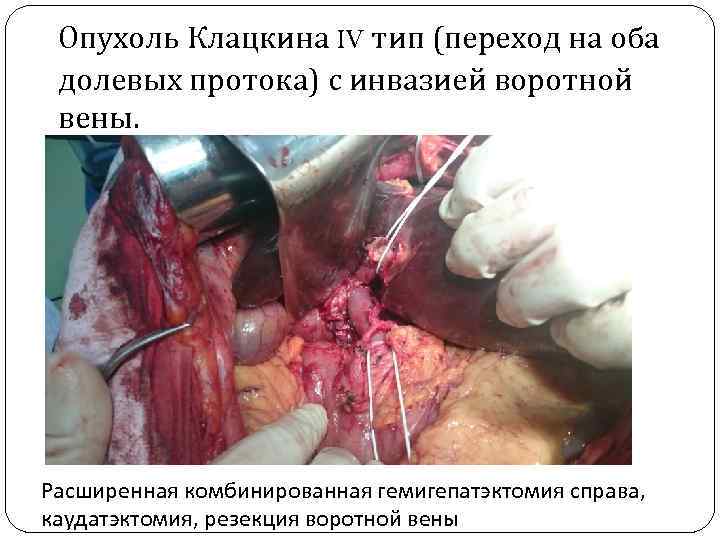 Опухоль Клацкина IV тип (переход на оба долевых протока) с инвазией воротной вены. Расширенная