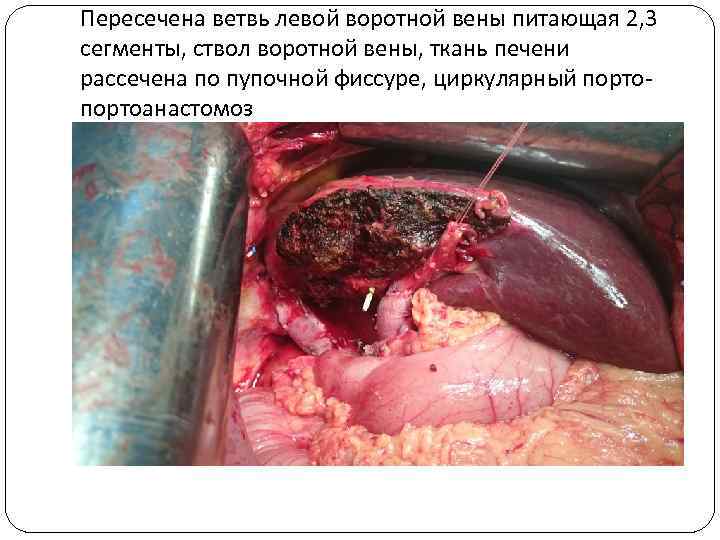 Пересечена ветвь левой воротной вены питающая 2, 3 сегменты, ствол воротной вены, ткань печени