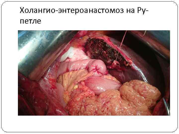 Холангио-энтероанастомоз на Рупетле 
