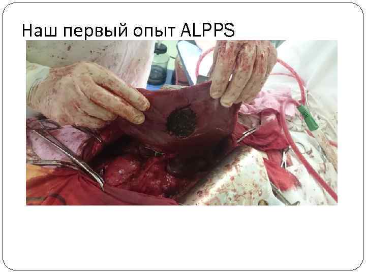 Наш первый опыт ALPPS 