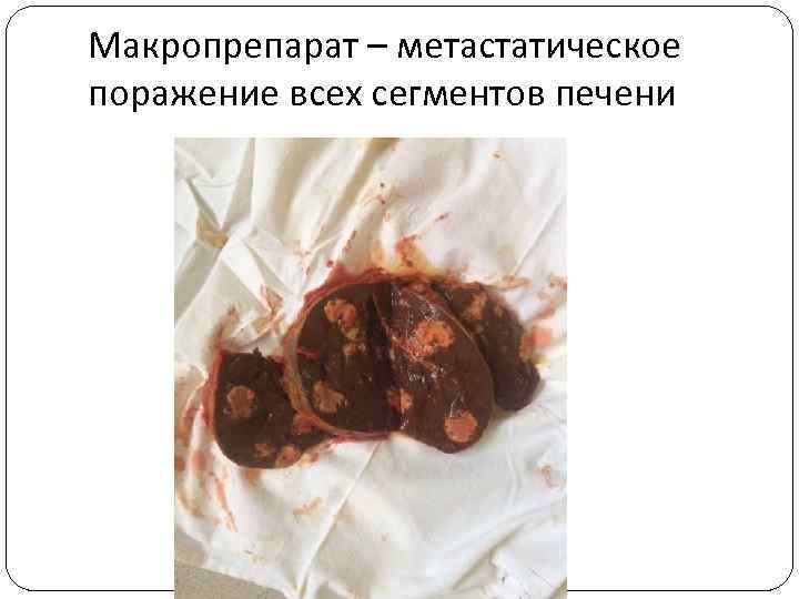 Макропрепарат – метастатическое поражение всех сегментов печени 