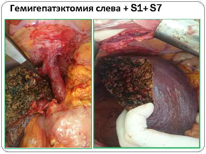 Гемигепатэктомия слева + S 1+ S 7 