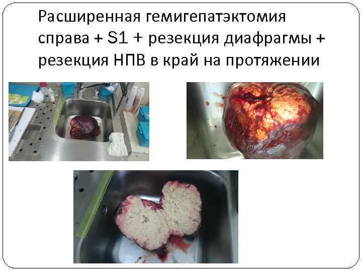 Расширенная гемигепатэктомия справа + S 1 + резекция диафрагмы + резекция НПВ в край