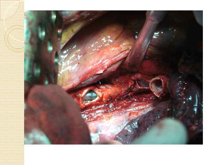  Сюда бронхопластики фото 