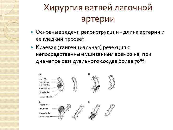 Хирургия ветвей легочной артерии Основные задачи реконструкции - длина артерии и ее гладкий просвет.