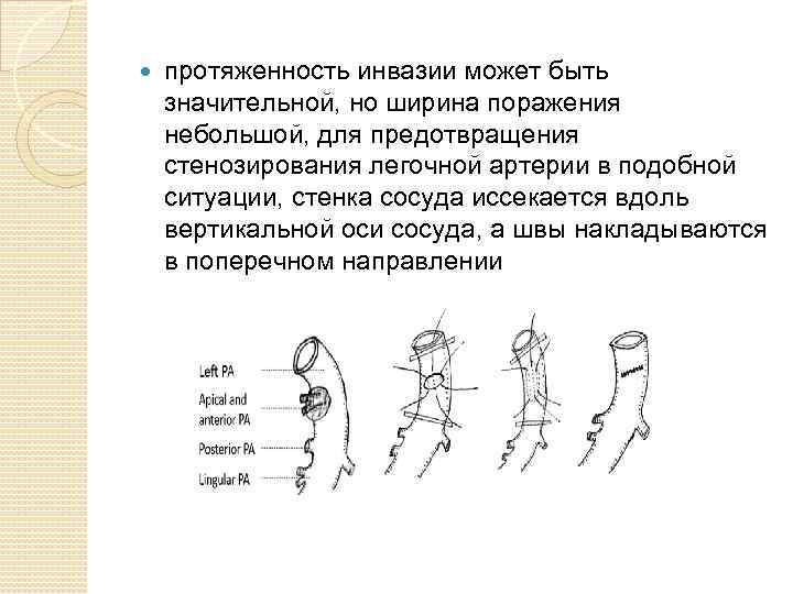  протяженность инвазии может быть значительной, но ширина поражения небольшой, для предотвращения стенозирования легочной