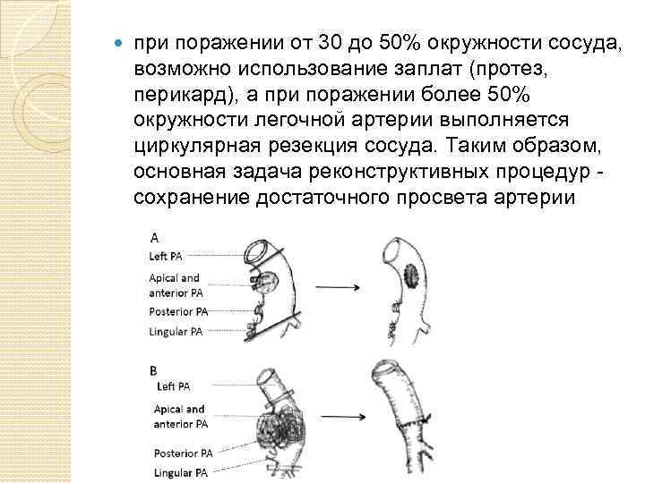  при поражении от 30 до 50% окружности сосуда, возможно использование заплат (протез, перикард),