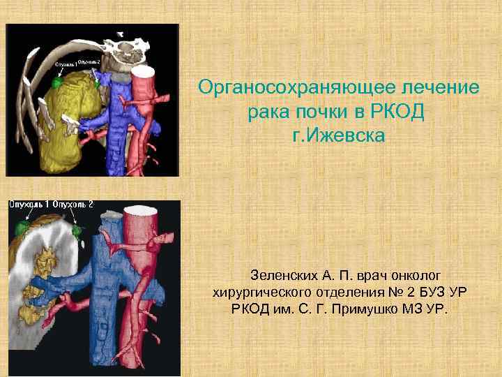 Органосохраняющее лечение рака почки в РКОД г. Ижевска Зеленских А. П. врач онколог хирургического