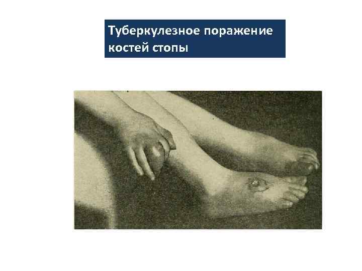 Туберкулезное поражение костей стопы 
