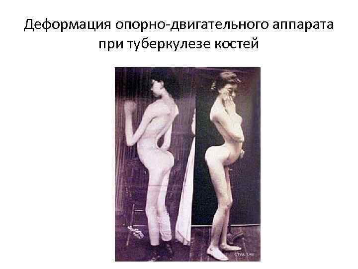 Деформация опорно-двигательного аппарата при туберкулезе костей 