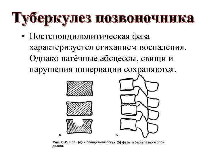 Туберкулез позвоночника • Постспондилолитическая фаза характеризуется стиханием воспаления. Однако натёчные абсцессы, свищи и нарушения