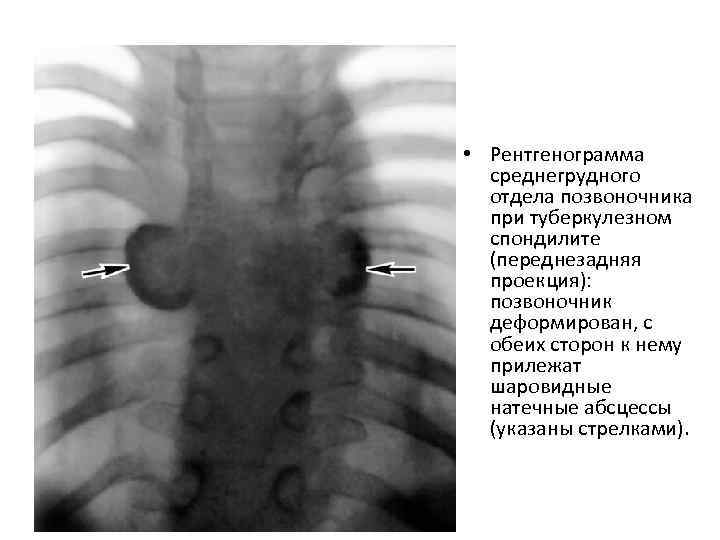  • Рентгенограмма среднегрудного отдела позвоночника при туберкулезном спондилите (переднезадняя проекция): позвоночник деформирован, с