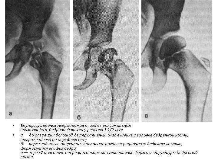  • • Внутрисуставная некрэктомия очага в проксимальном эпиметафизе бедренной кости у ребенка 1