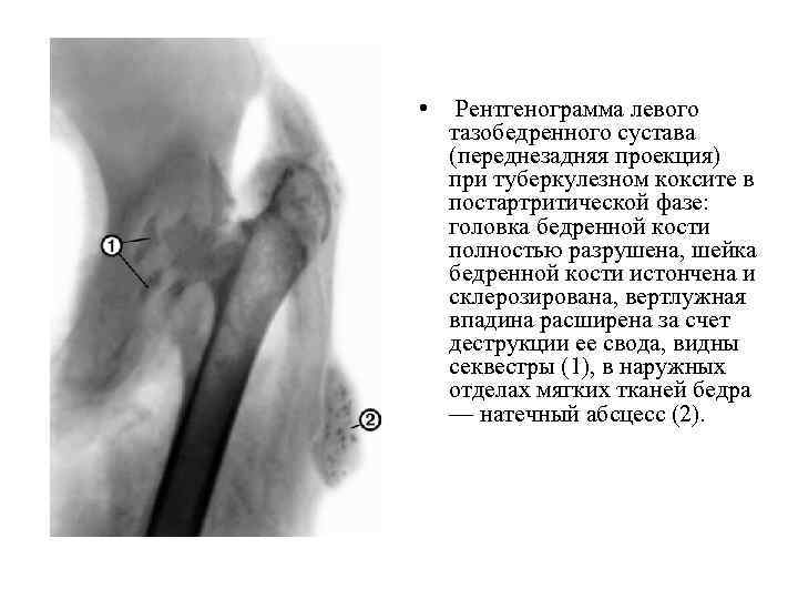  • Рентгенограмма левого тазобедренного сустава (переднезадняя проекция) при туберкулезном коксите в постартритической фазе: