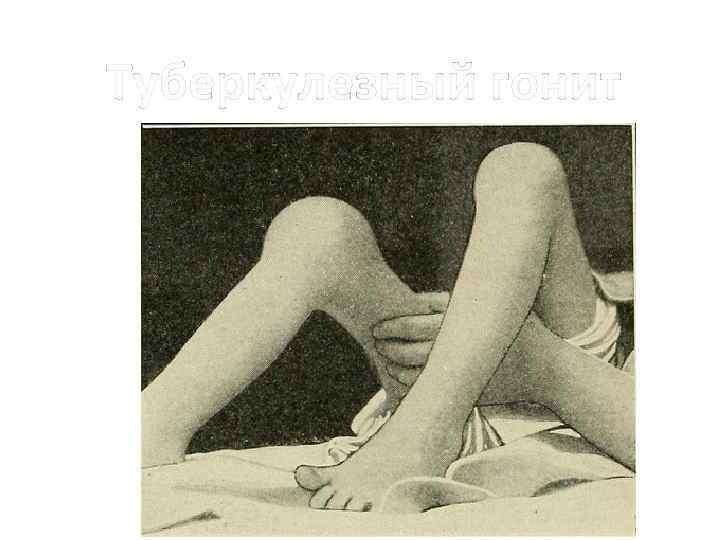 Туберкулезный гонит 