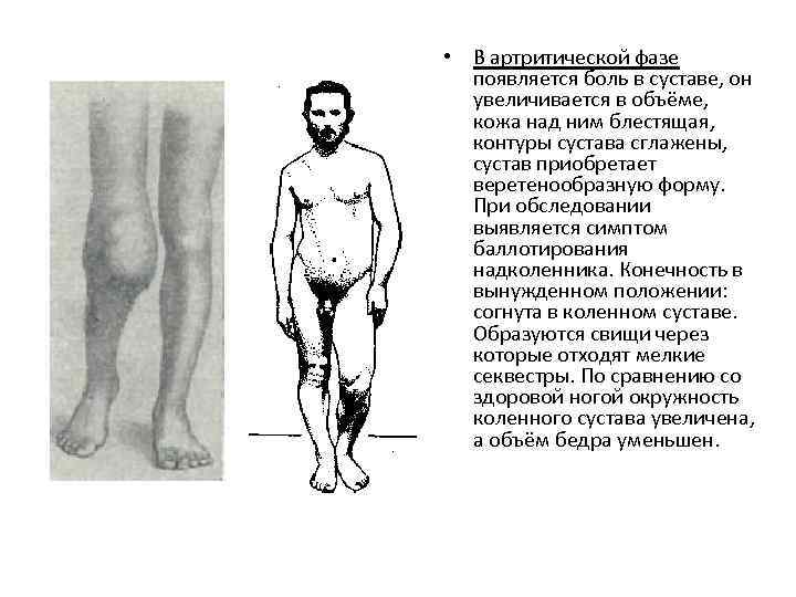  • В артритической фазе появляется боль в суставе, он увеличивается в объёме, кожа